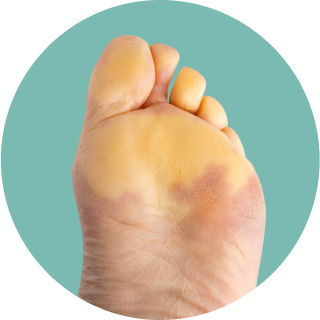 Systemic Sclerosis (SSc)