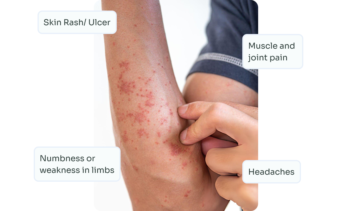 Vasculitis
