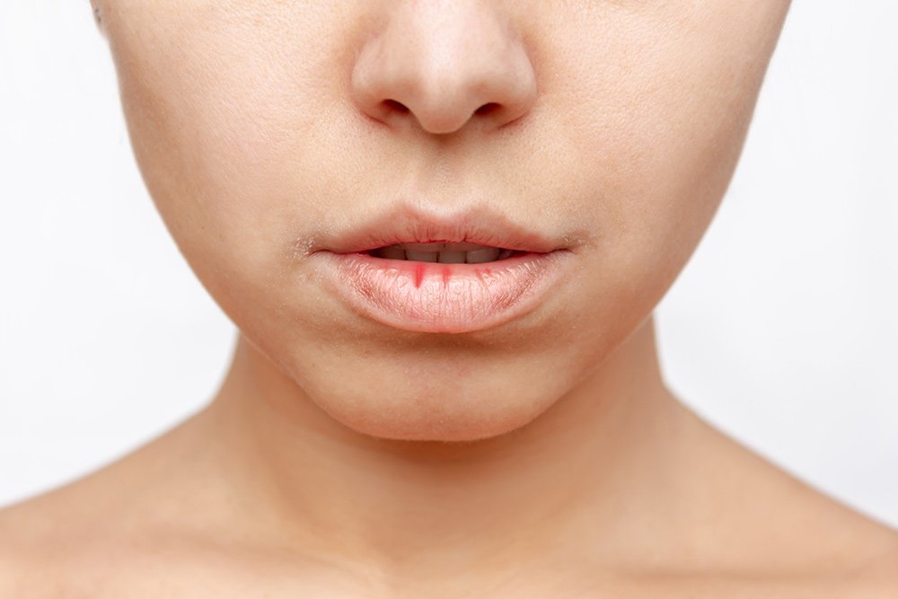Sjogren disease